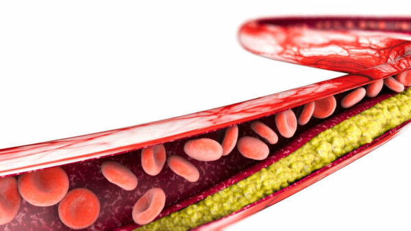 زيادة نسبة الكوليسترول فى الدم