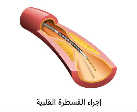 القسطرة القلبية