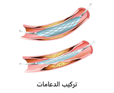 تركيب الدعامات